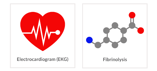 EKG and fibrinolysis 