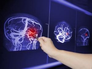 person pointing to a brain injury on an x-ray