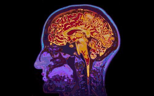 Diffuse Tensor Imaging Used in Detecting Traumatic Brain Injury