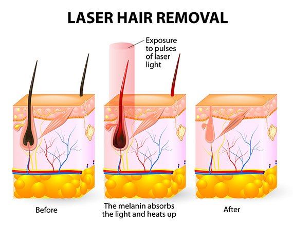 Laser Hair Remove Photo